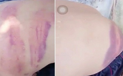 Xác minh vụ người đàn ông bầm tím khắp lưng nghi bị "vợ hờ" đánh ở Nghệ An