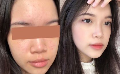 Từng bị mụn ẩn sần mặt, cô bạn giờ có làn da láng mịn phát hờn nhờ quy trình skincare kết hợp thông minh đồ bình dân và đắt tiền