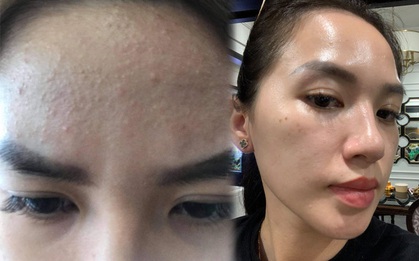 Mụn nổi sần khắp trán, cô gái vẫn “lột xác” da láng mịn nhờ quy trình skincare với combo 4 sản phẩm bình dân The Ordinary
