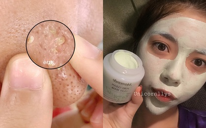 Cảm giác mụn đầu đen cứ nặn rồi lại mọc, bạn chỉ cần kiên trì dùng 6 loại mặt nạ này là da mịn nhẵn thín