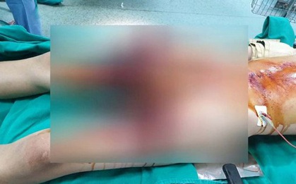 Học chế tạo pháo trên mạng, nam sinh 13 tuổi dập nát bàn tay