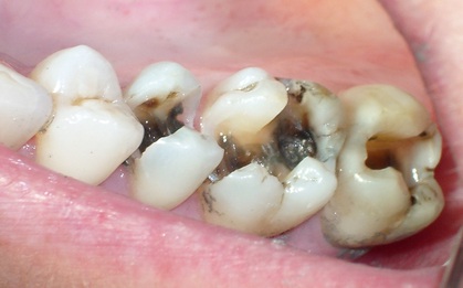 6 dấu hiệu điển hình cảnh báo nguy cơ lão hóa răng sớm mà nhiều người chẳng ngờ đến