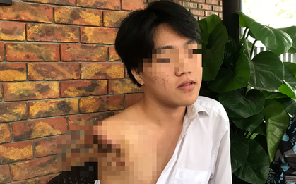 Nam sinh 16 tuổi bị máy tiện cuốn đứt lìa cánh tay trong giờ học thực hành