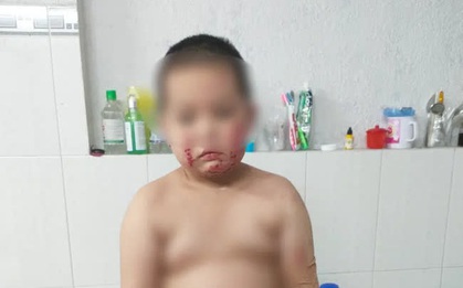 Vụ cha đóng cửa nhà châm lửa đốt khiến 2 con bỏng nặng, bản thân tử vong tại TP.HCM: Người mẹ bị sốc tâm lý, lúc tỉnh lúc mê