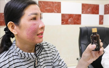 Nhiều chị em bị tai biến do làm trắng da cấp tốc đón Tết