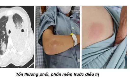 Sưng tấy "vòng 1", đi khám cô gái mới biết mắc bệnh truyền nhiễm nguy hiểm