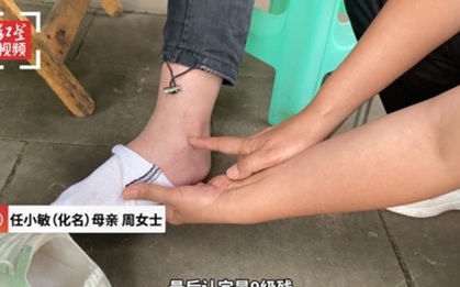 Nữ sinh 13 tuổi bị thương tật vĩnh viễn chỉ vì dám mang 1 thứ vào trong phòng ký túc xá