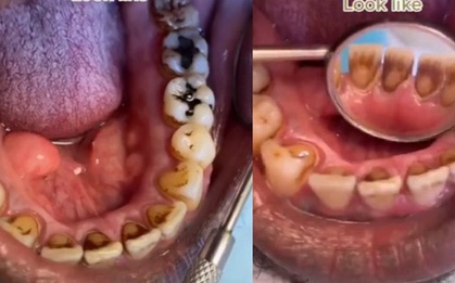 Bác sĩ chia sẻ video gây sốc cho thấy tác hại của thuốc lá