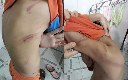 Bé trai lớp 1 bị cha ruột bạo hành vì học hành không tiến bộ