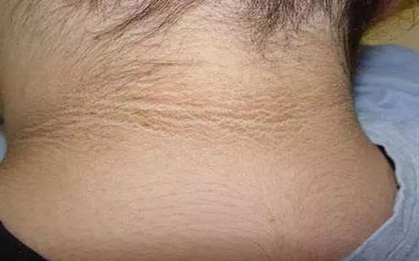 Thiếu nữ 15 tuổi có "vết bẩn" ở cổ nhưng rửa mãi không sạch, bác sĩ ngạc nhiên: đây là bệnh đó!