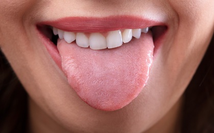 Bị sùi mào gà dọc cuống lưỡi, bệnh nhân vẫn cãi bác sĩ "sùi mào gà sao mọc được ở trong mồm"