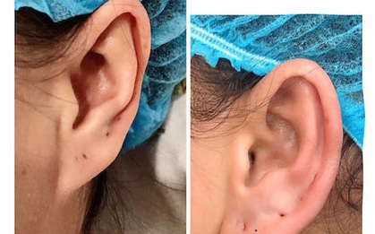 Tiêm filler để có tai to hứng tài lộc, "đổi vận" hay "mạt vận"