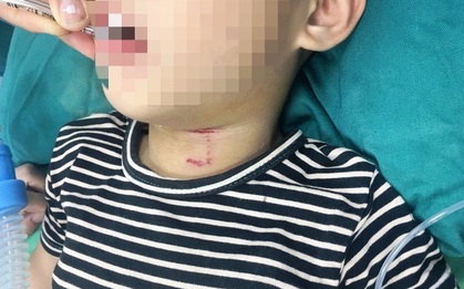 Nghệ An: Bé trai 3 tuổi bị chó cắn rách vùng cổ, thủng khí quản