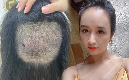 Chi 90 triệu để cấy tóc "trị" trán dô: Cô nàng này thú nhận từng bất an cực độ vì tóc rụng lả tả, sau nửa năm mới dám thở phào nhẹ nhõm