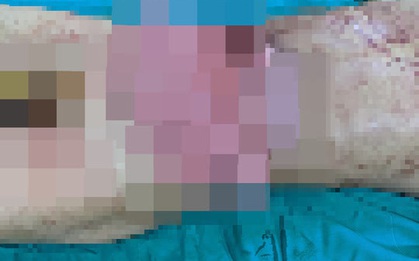 Thiếu niên bị tai nạn hy hữu khiến ruột ở ngoài ổ bụng