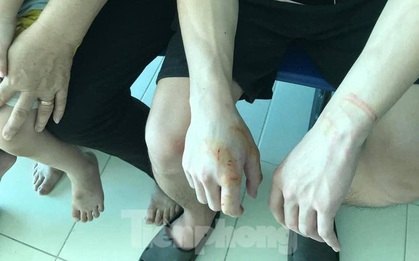 Kinh hoàng chó dại cắn liên tiếp 6 người ở Lạng Sơn
