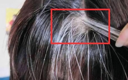 Tóc trắng mọc trên trán, thái dương và sau đầu cảnh báo điều gì? Làm được 4 việc này tóc trắng còn lâu mới xuất hiện