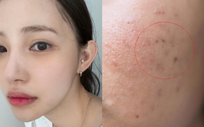 2 cách đơn giản trị sẹo rỗ, tăng sinh collagen được bác sĩ da liễu khuyên dùng