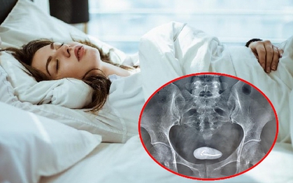 Những ca que tránh thai "đi lạc" hi hữu và 3 việc cần làm để đảm bảo an toàn