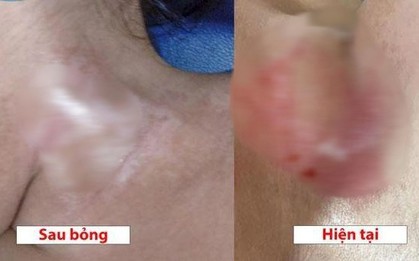 Bé gái 19 tháng tuổi bỏng nặng vì lọ dung dịch hầu hết "nhà nào cũng có"