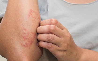 Căn bệnh "ưa" thời tiết lạnh, khô khiến da ngứa ngáy: Chuyên gia chỉ cách đối phó