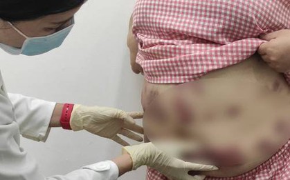 Quý bà "tan nát" cơ thể vì mê làm đẹp cấp tốc