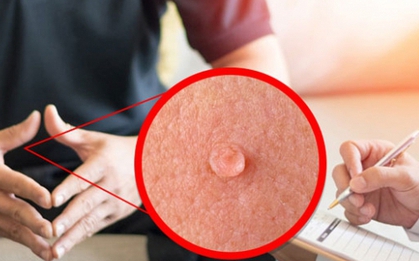 Bệnh tình dục gia tăng ở nhóm người trẻ, có người điều trị sùi mào gà 15 lần không khỏi
