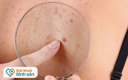 Đừng bỏ qua 4 biểu hiện bất thường trên da vì nó có thể là dấu hiệu sớm của bệnh ung thư