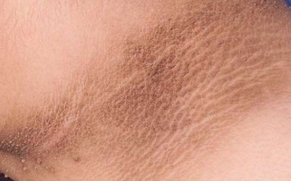 Không phân biệt nam hay nữ, nếu trên cổ xuất hiện 3 điểm bất thường thì chứng tỏ tế bào ung thư đang âm thầm tìm đến
