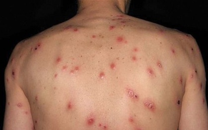 Phát ban loang lổ đầy người, nam thanh niên trả giá đắt vì quan hệ tình dục bừa bãi