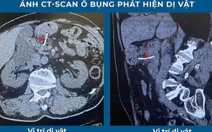 Cụ ông suýt chết vì bị xương cá xuyên thủng dạ dày