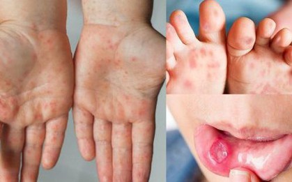 Khẩn: Đã có 5.545 ca mắc tay chân miệng, 1 trường hợp tử vong, Bộ Y tế dự báo dịch có thể gia tăng