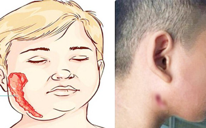BS Trương Hữu Khanh nói về căn bệnh bị gọi tên "vi khuẩn ăn thịt người"