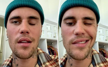 Justin Bieber gặp khó khăn trong ăn uống sau khi liệt nửa mặt