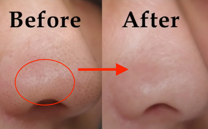 Cách trị sạch mụn đầu đen dành cho nàng "kinh tế eo hẹp"