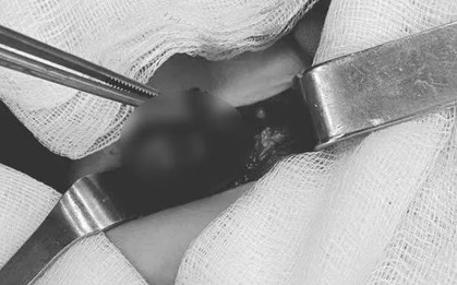 Bé trai 10 tháng tuổi phải cắt tinh hoàn do bị xoắn hoại tử