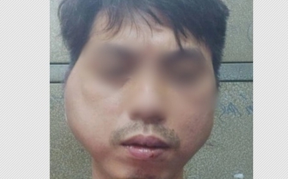 Nhân viên tố bị chủ quán đánh biến dạng khuôn mặt
