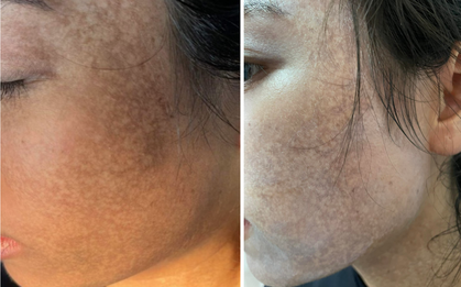 Mặt cô gái trẻ đen sạm sau khi chi 70 triệu đồng để lăn kim, lột da trị nám tại spa
