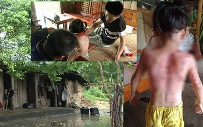 Hoàn cảnh đáng thương của gia đình cháu bé bị hàng xóm dội nước sôi vào người