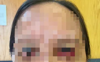 Cứu chữa đôi mắt lật ngược, trợn trừng sau làm đẹp của người phụ nữ
