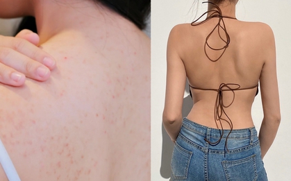 6 cách khắc phục mụn lưng hiệu quả tại nhà