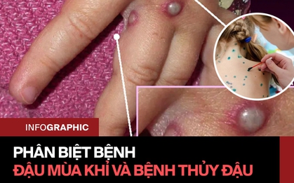 Phân biệt bệnh đậu mùa khỉ và thủy đậu: Triệu chứng, sự lây truyền và tổn thương khác nhau thế nào?