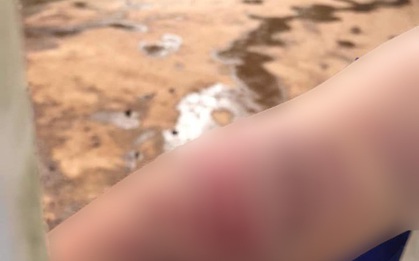 Vụ cháu bé 9 tuổi bị bà và cha đánh đập dã man: Người mẹ nói gì?