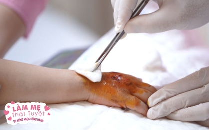 Bé 4 tuổi gãy tay, bị hoại tử nghiêm trọng do đắp lá của thầy lang