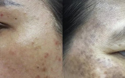 Đắp thần dược trị nám, mặt người phụ nữ trẻ xám xịt, loang lổ