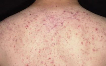 Suýt tử vong sau 30 phút lăn kim trị mụn ở lưng