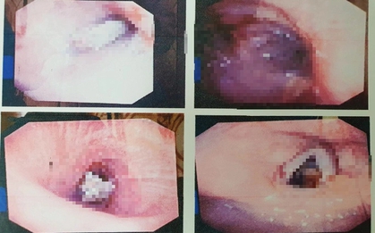 Người đàn ông gặp nạn khi ăn xương ống heo