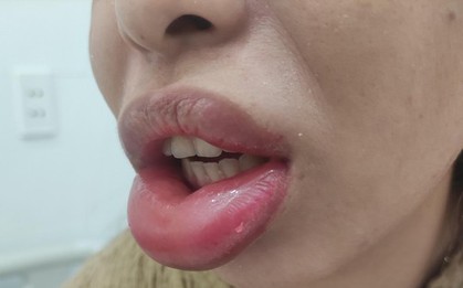Liên tiếp 2 bệnh nhân bị tai biến thẩm mỹ sau tiêm filler