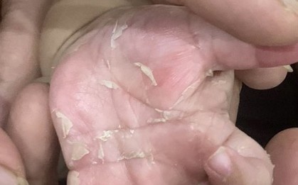 Nguyên nhân không ngờ khiến bé trai 3 tháng tuổi mắc bệnh giang mai