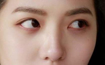 Nữ sinh viên bị đột quỵ mắt, da nhăn nheo vì 1 thói quen nhiều người trẻ hay làm